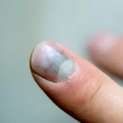Zasiniony paznokieć po urazie, z widocznym krwiakiem i pęknięciem.